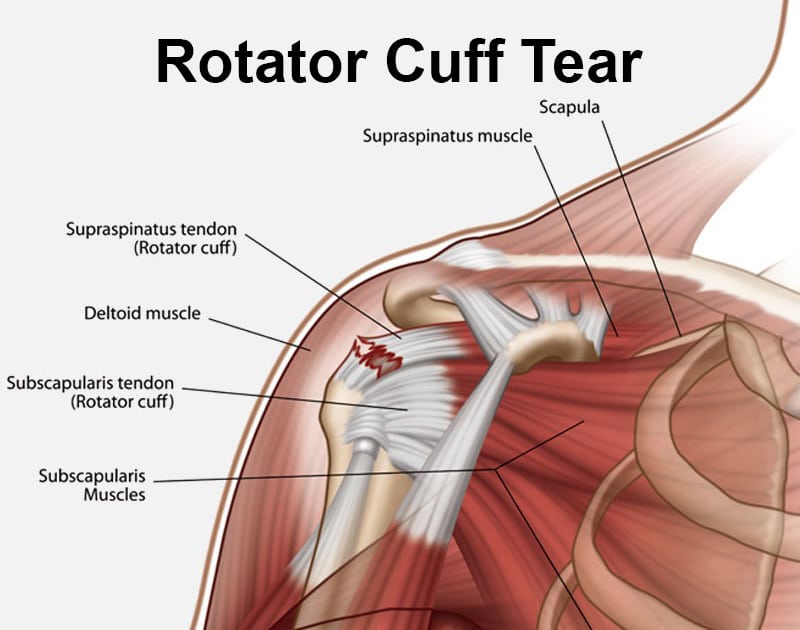 How to Help Your Rotator Cuff After an Injury or Degeneration - In